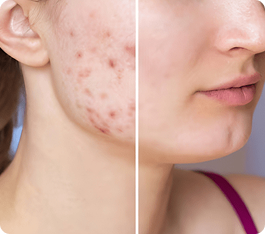 Acne & Acne Scars Concerns