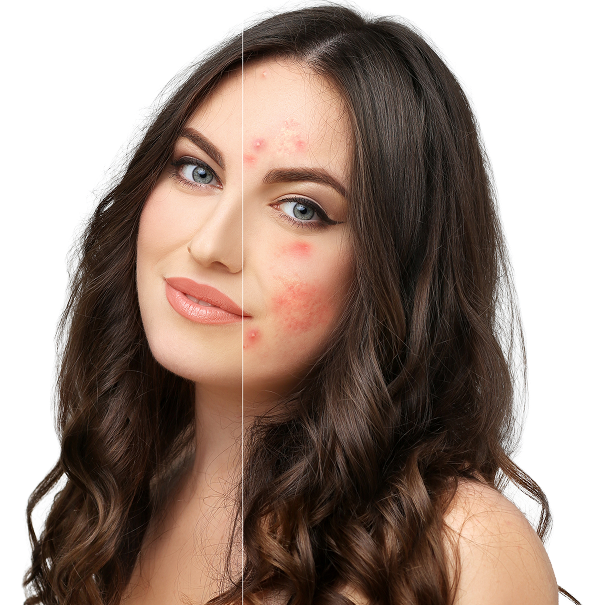 Acne and Acne Scars Concerns
